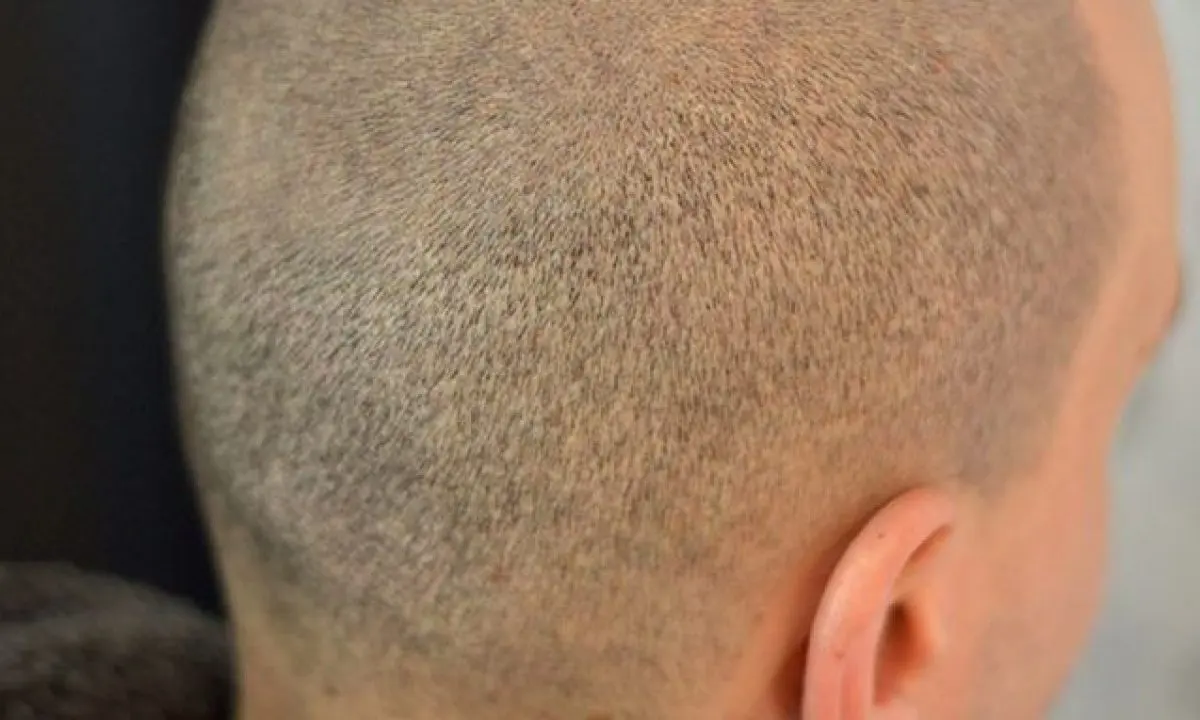 Der Entnahmebereich nach einer FUE-Haartransplantation, ohne sichtbare Spuren verheilt