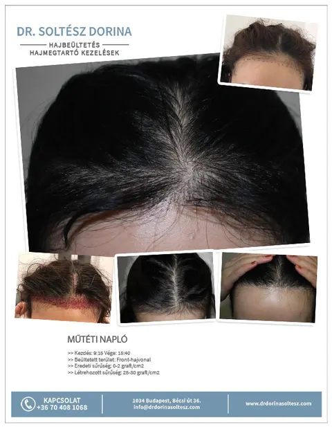 Long Hair FUE hajbeültetés előtte-utána eredménye, 1100 graft