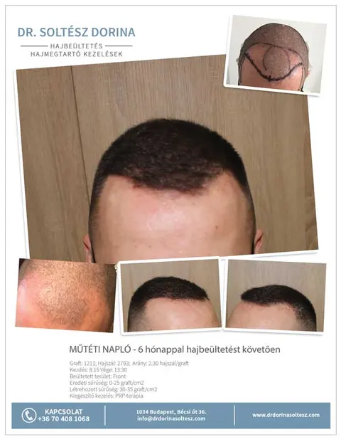 Hajbeültetés előtte-utána eredménye, 1211 graft, 2793 hajszál