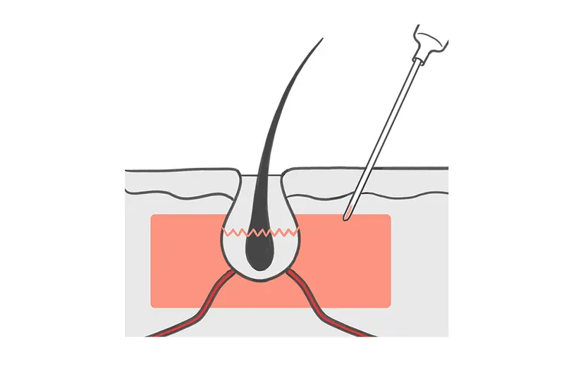 Thrombozytenreiches Plasma, 2 bis 3 mm tief auf Höhe des Haarfollikels in die Kopfhaut injiziert