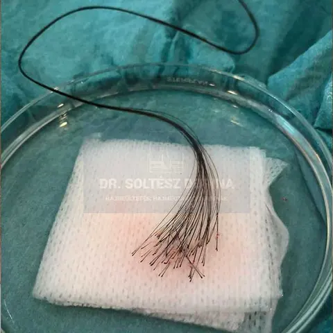 Long Hair FUE — teljes hajhosszal átültetett graftok, borotválás nélkül