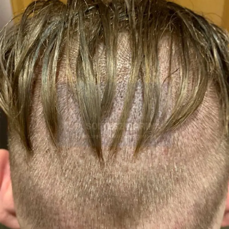 Partially-shaven FUE hajbeültetési technika