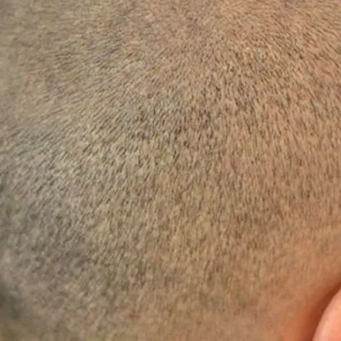 Shaven FUE hajbeültetési technika